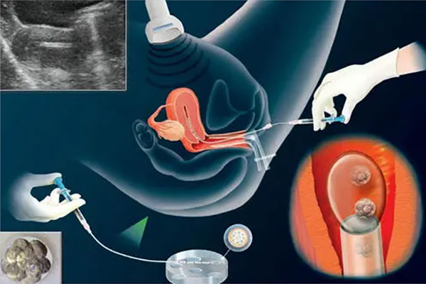 体外受精的步骤过程介绍