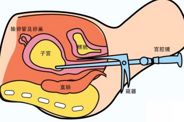 宫腔镜手术后怎样调养