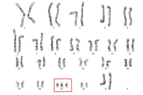 13号染色体常见异常汇总
