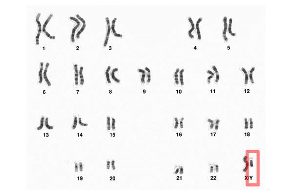 y染色体微缺失