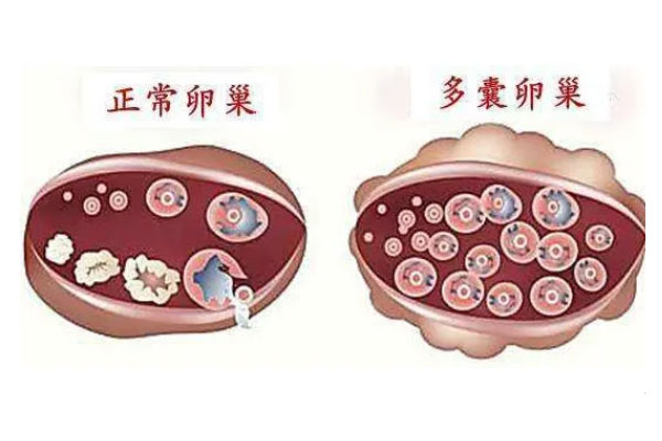 正常卵巢和多囊卵巢的区别
