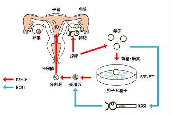 什么是体外受精