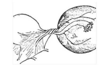 试管婴儿促排卵要防止卵巢扭转!(图1)
