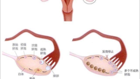 多囊卵巢综合征是怎样的一种疾病？