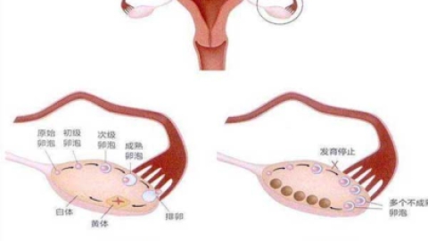 多囊卵巢怎么备孕才能成功？除了试管还有这2种