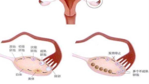 多囊卵巢降低体重5-10%可以使80%以上的患者恢复排