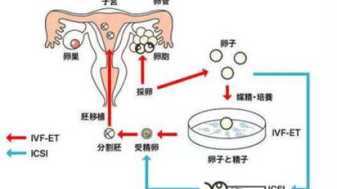 卵胞浆内单精子注射（ICSI）出生的男孩会不会不