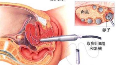 做试管婴儿取卵到底有多痛？别怕痛，做好这几