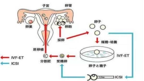 想要“好孕”，请了解胚胎移植手术的过程！