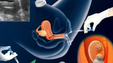 体外受精的过程是什么?