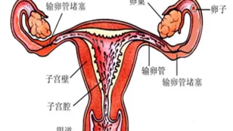 输卵管堵塞的原因是什么，能彻底根治吗？